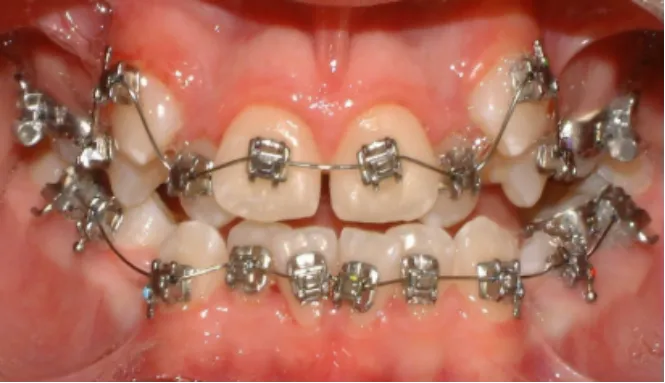 Orthodontic case 1