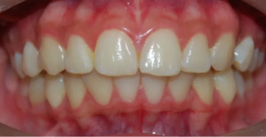 Orthodontic case 4