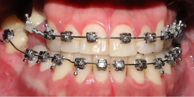 Orthodontic case 6